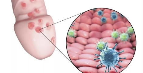 Прищі на головці члена - перламутрові папули у чоловіків