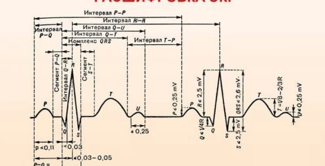 Как расшифровать кардиограмму