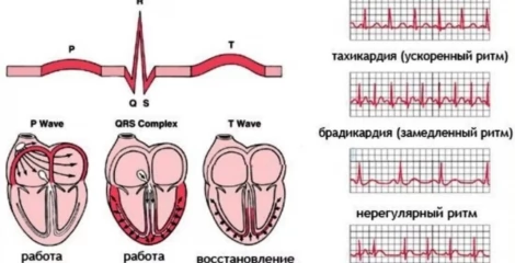 Синусовая брадикардия