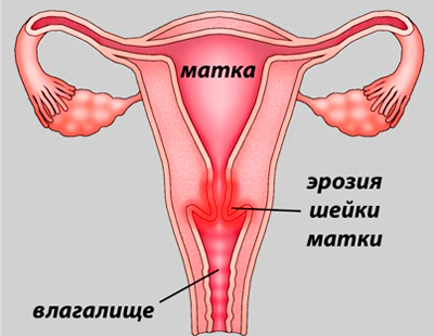 Эрозия шейки матки, лечение в Киеве. Клиника гинекологии Медиленд