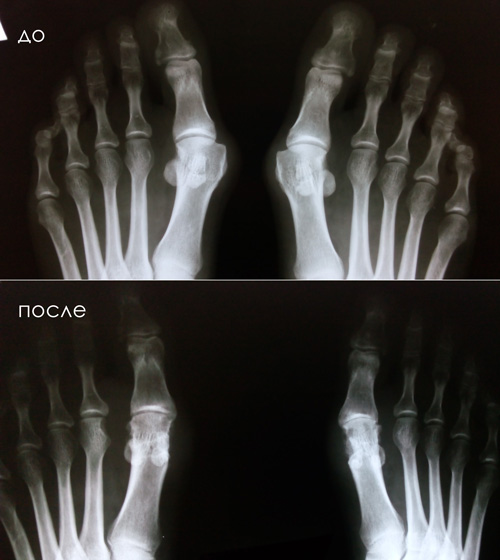Рентген стоп до и после операции Халлюкс Вальгус