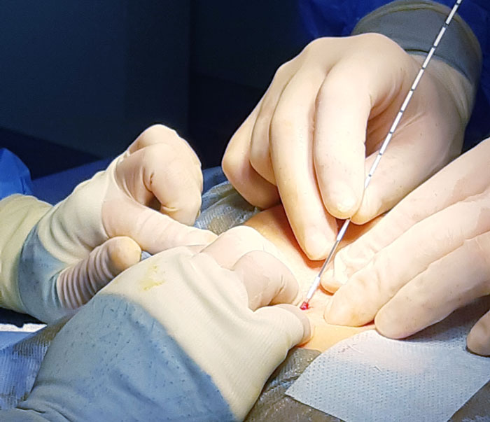 Пример проведения лазерного лечения пилонидального синуса в центре проктологии Медиленд, Киев