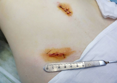 После операции по удалению дермоидной кисты яичника, фото в Киеве