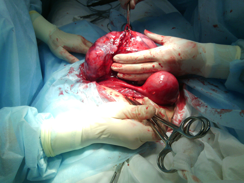 Ход операции по удалению многоузловой миомы матки больших размеров в Киеве, фото