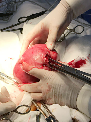 Фото 11. Экстирпация матки, в данном случае сохранить орган невозможно