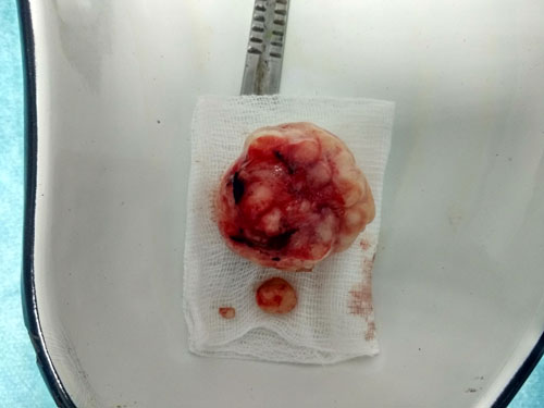 Фото 5. Консервативная миомэктомия - удалённые узлы миомы во время операции