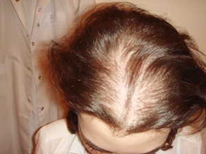 Проведение имплантации волос в Киеве, Медиленд