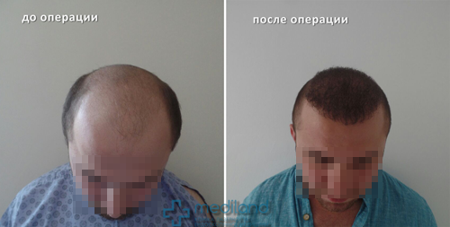 Фото 1 Пересадка волос до и после