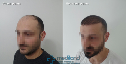 Фото 3 Трансплантація волосся у чоловіків до і після фото