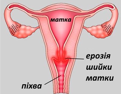 Эрозия шейки матки, лечение в Киеве. Клиника гинекологии Медиленд